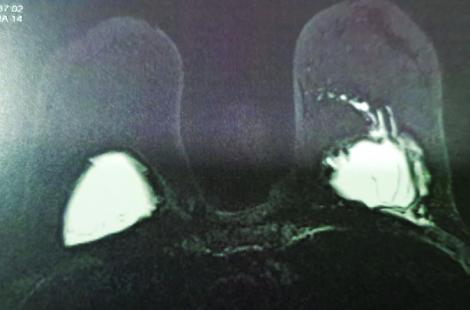 Rupture extra-capsulaire de la prothèse mammaire gauche avec siliconomes, vue à l'IRM. 