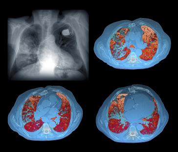 Les scanners prescrits dans le dépistage du cancer du poumon pourraient aussi être utiles
