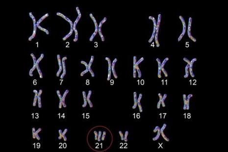 trisomie 21 caryotype