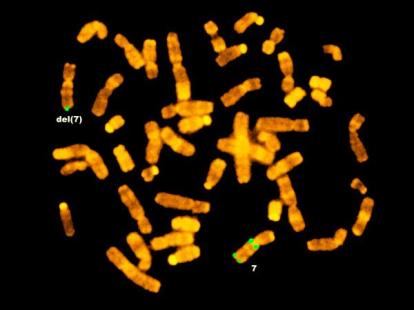 Microscopie d'une hybridation in situ fluorescente (FISH) montrant les chromosomes d'un patient atteint du syndrome de Williams.