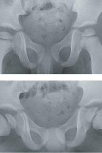 Ostochondite primitive de hanche débutante ; le noyau fémoral supérieur est condensé sur la...