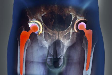 Prothèse de hanche totale versus partielle : des résultats quasi ...