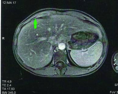 Cliché 1 : IRM du foie avec une lame péri-hépatique (flèche verte).