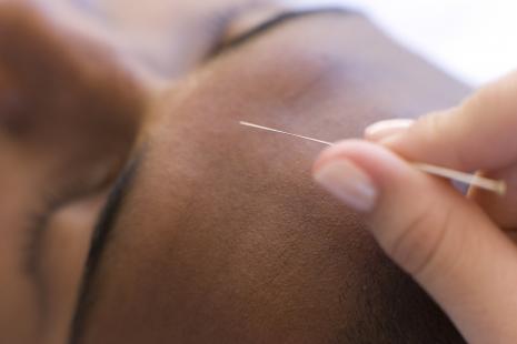 L'acupuncture est censée contribuer à atténuer le sentiment de faim pendant les cures