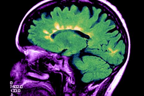Cerveau atteint de sclérose en plaques (IRM) - image d'illustration