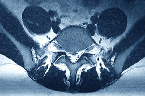 Imagerie par Résonance Magnétique (IRM) de la colonne lombaire d'une patiente de 30 ans souffrant d'une sciatique.