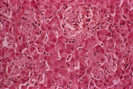Coupe d'un foie atteint de la maladie de Gaucher, due à l'absence de l'enzyme glucocérébrosidase (GC). Microscopie optique.